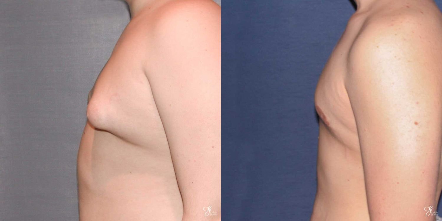Gynecomastia Correction Before & After