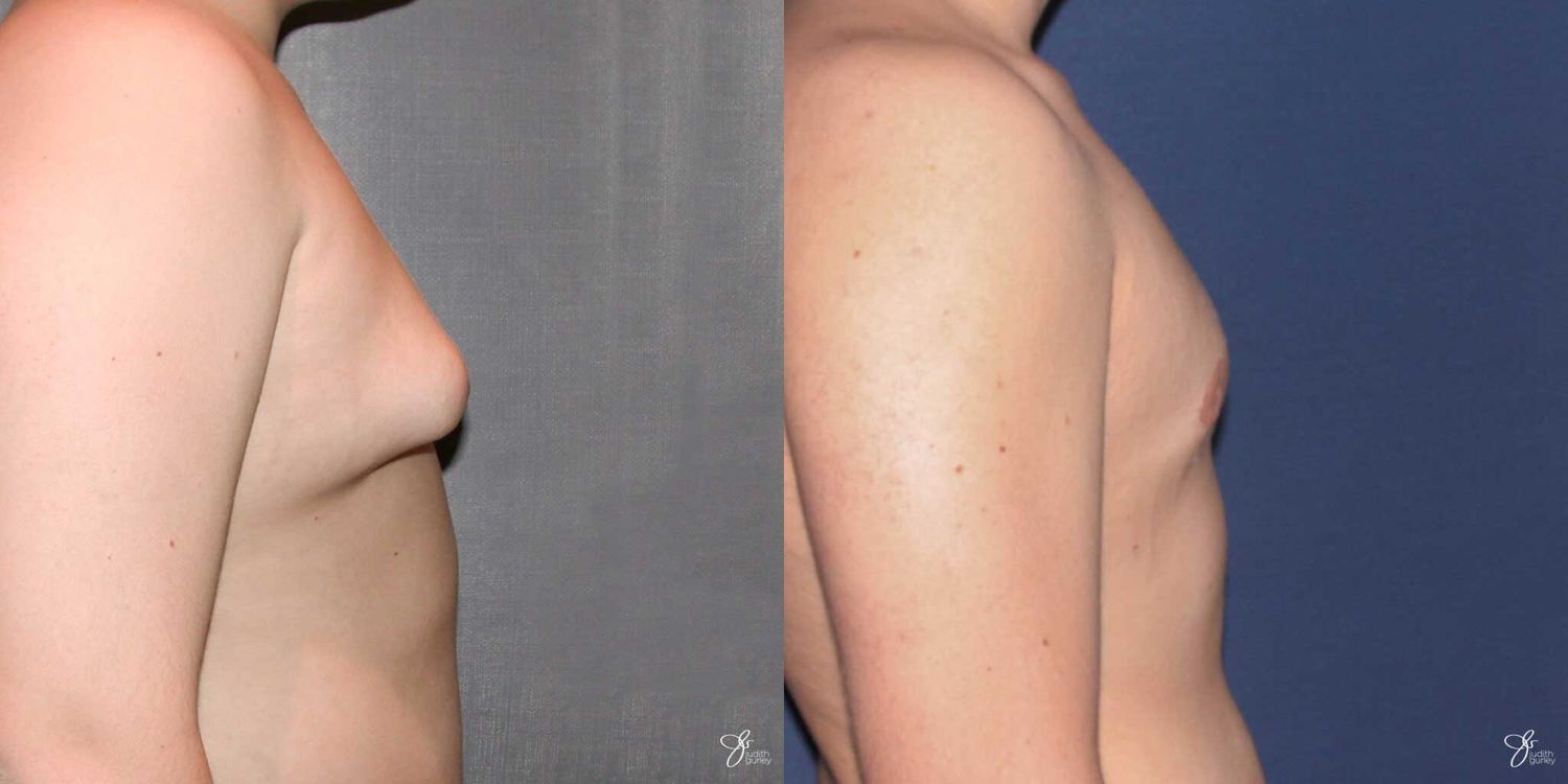 Gynecomastia Correction Before & After