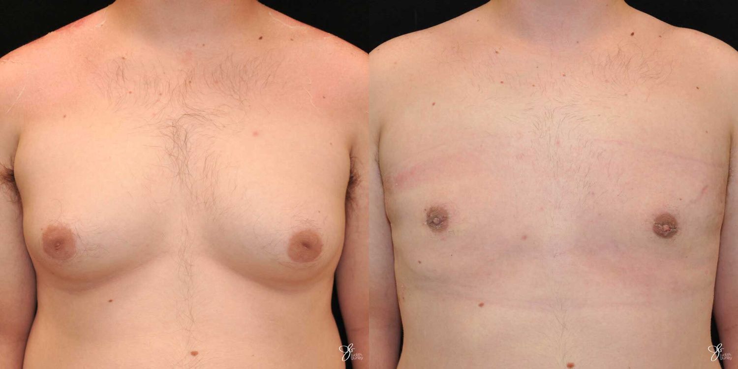 Gynecomastia Correction Before & After