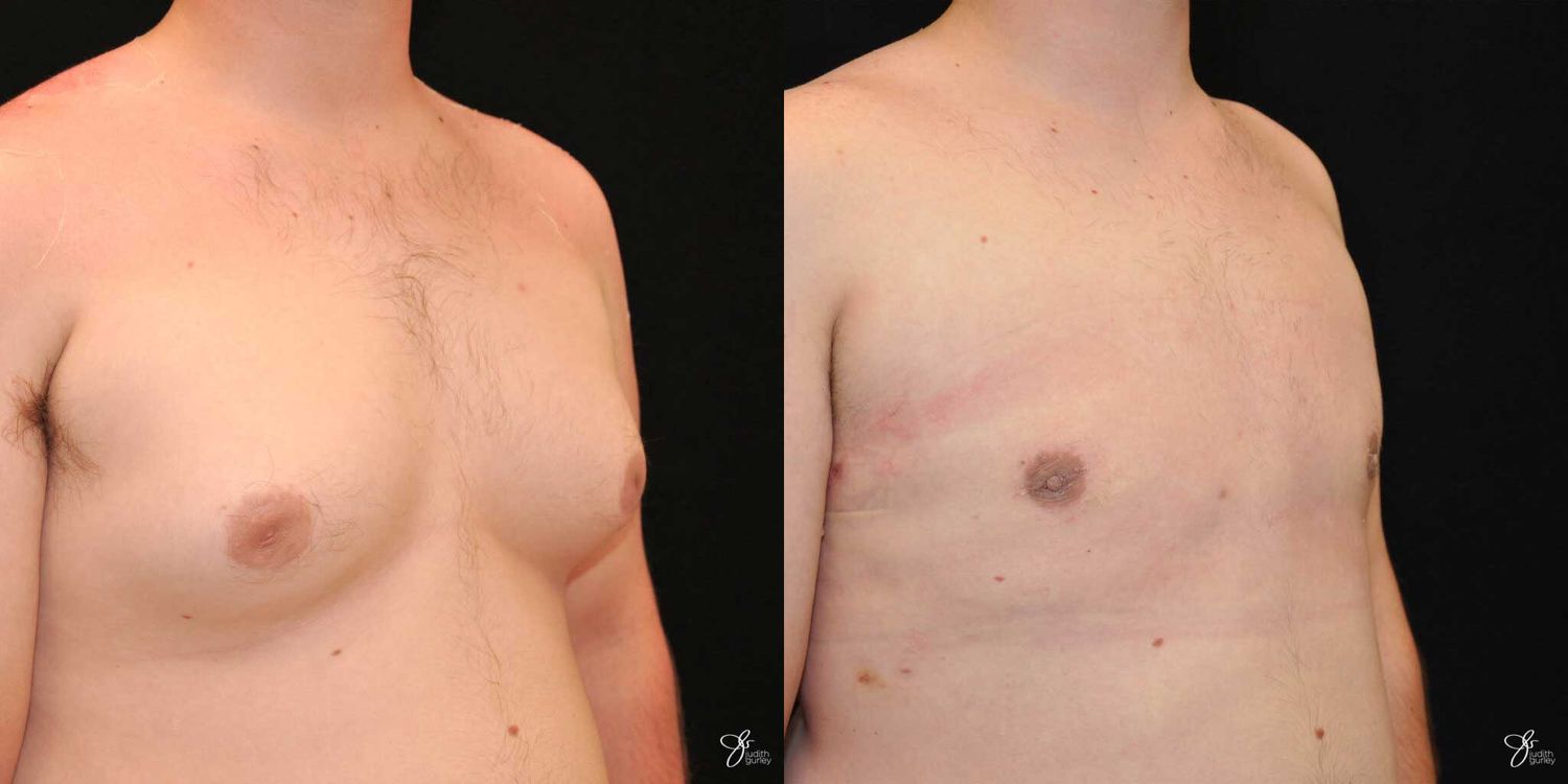 Gynecomastia Correction Before & After