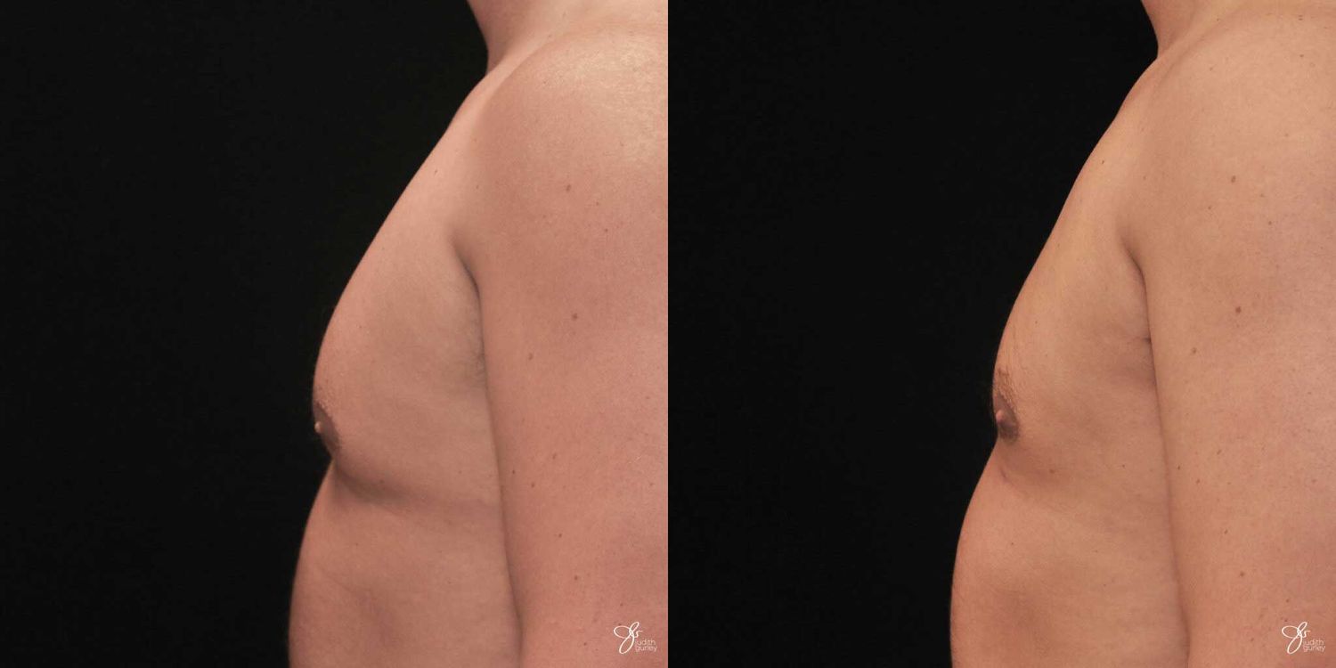 Gynecomastia Correction Before & After