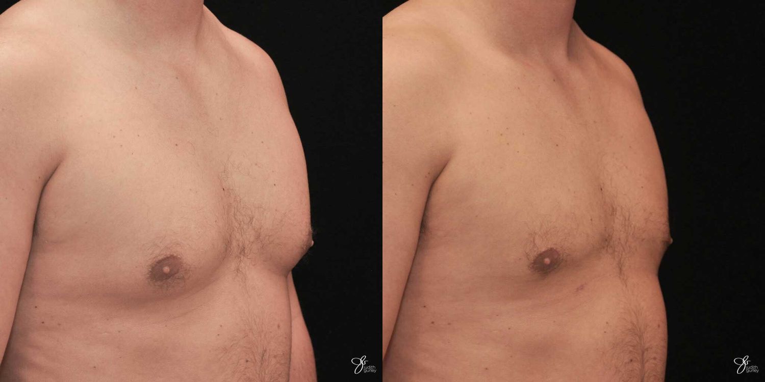 Gynecomastia Correction Before & After