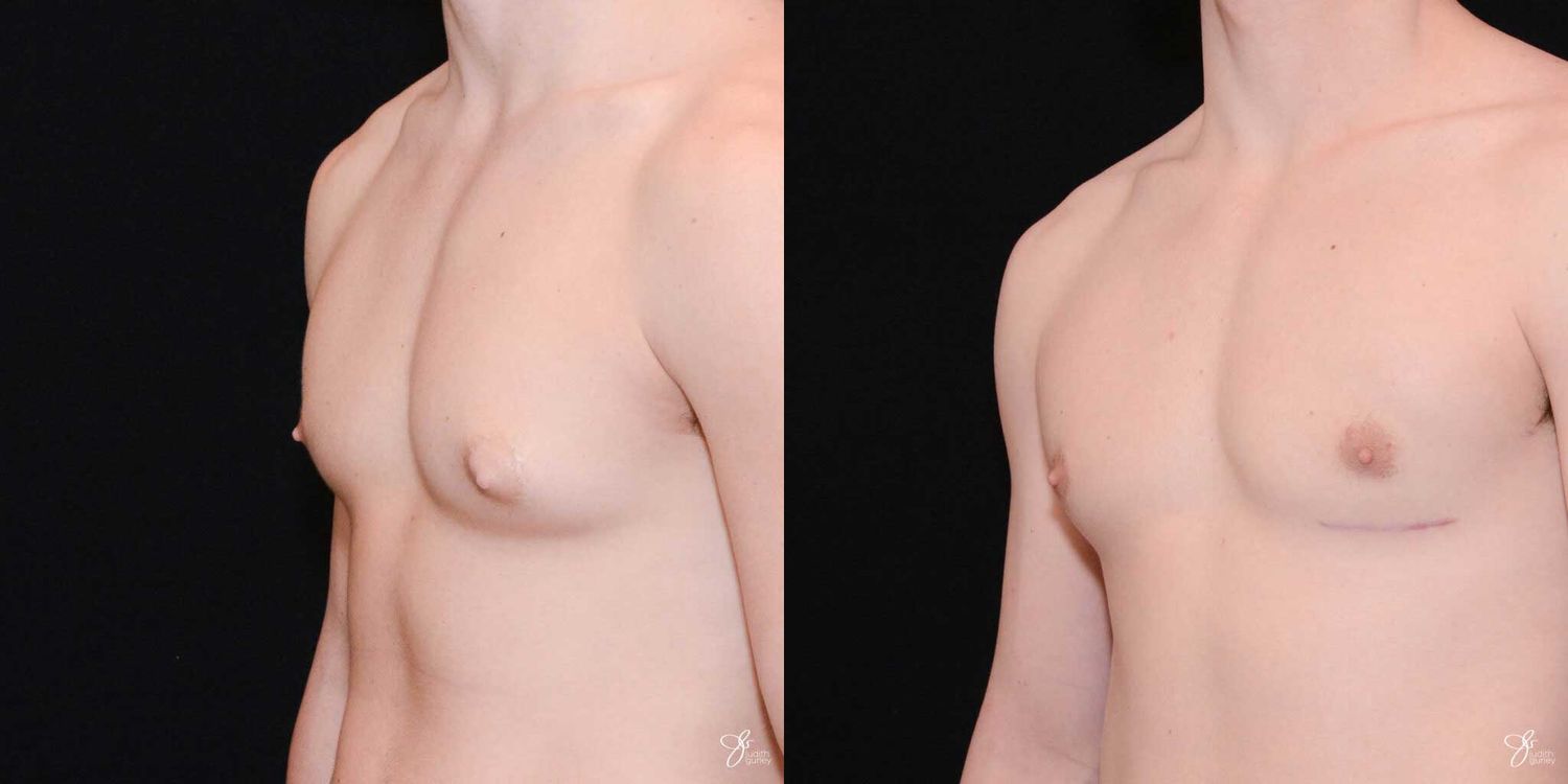 Gynecomastia Correction Before & After