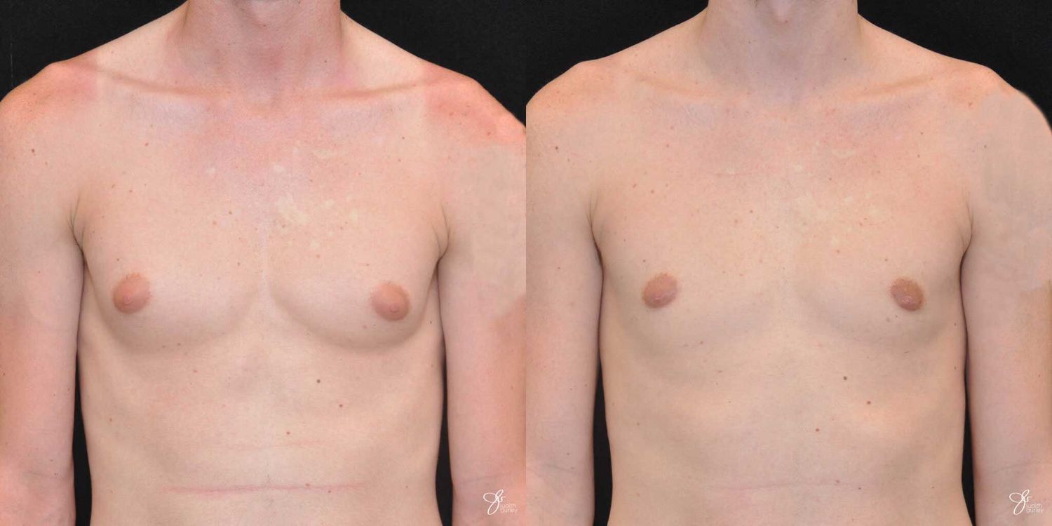 Gynecomastia Correction Before & After