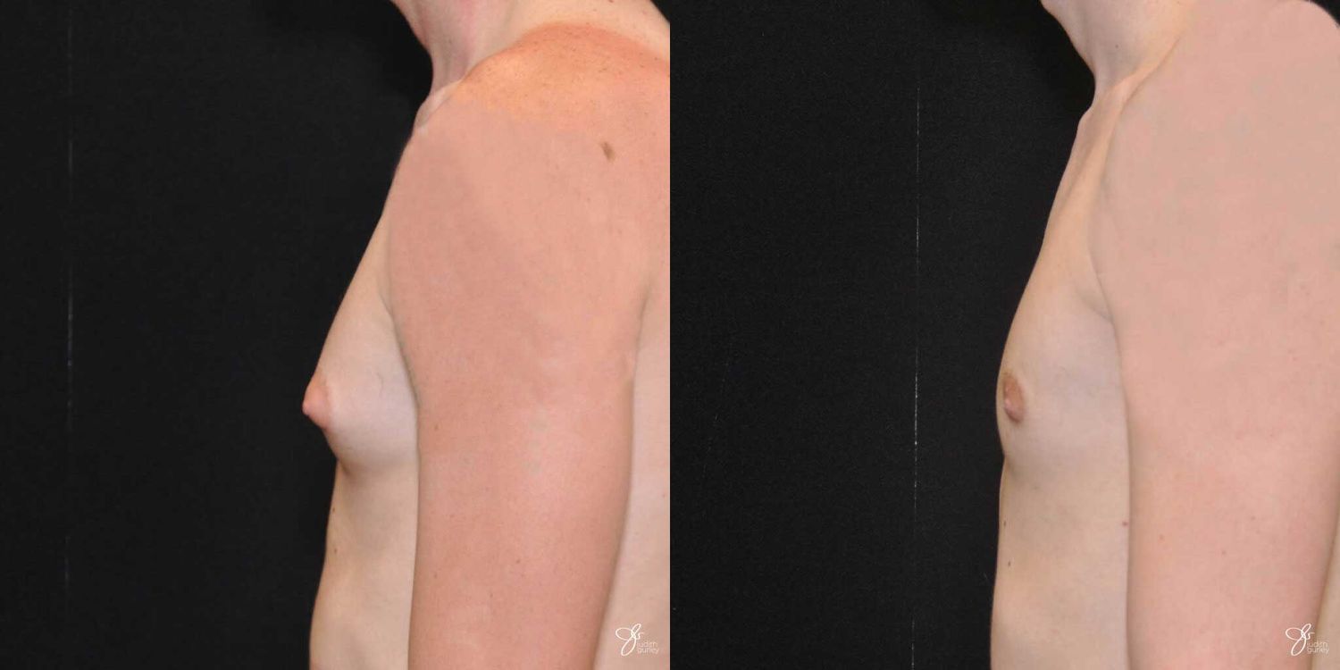 Gynecomastia Correction Before & After