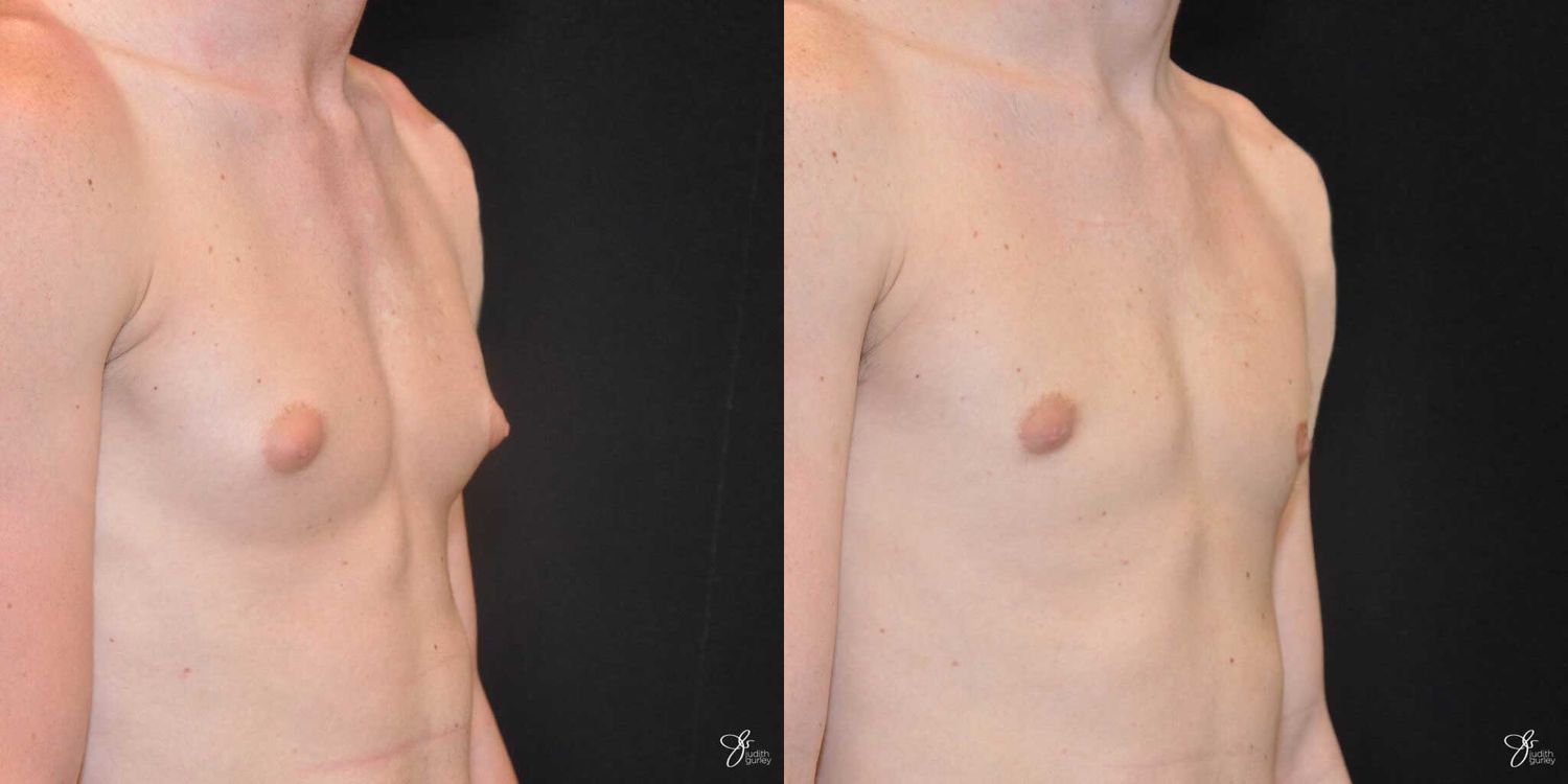 Gynecomastia Correction Before & After