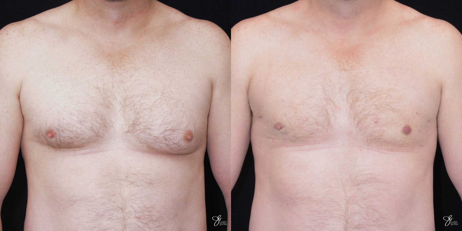 Gynecomastia Correction Before & After