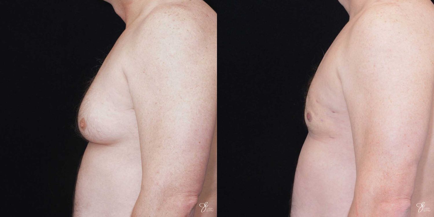 Gynecomastia Correction Before & After