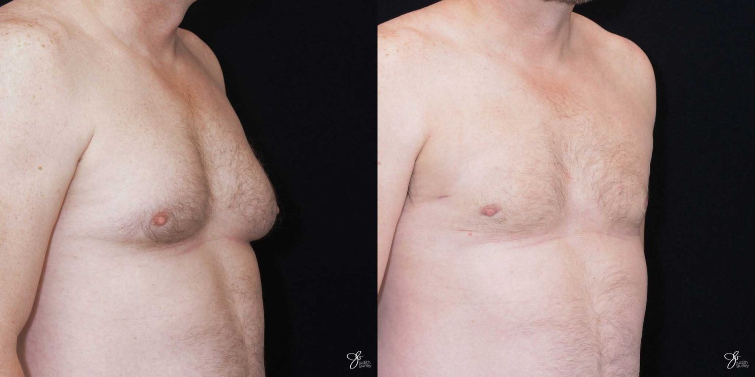 Gynecomastia Correction Before & After