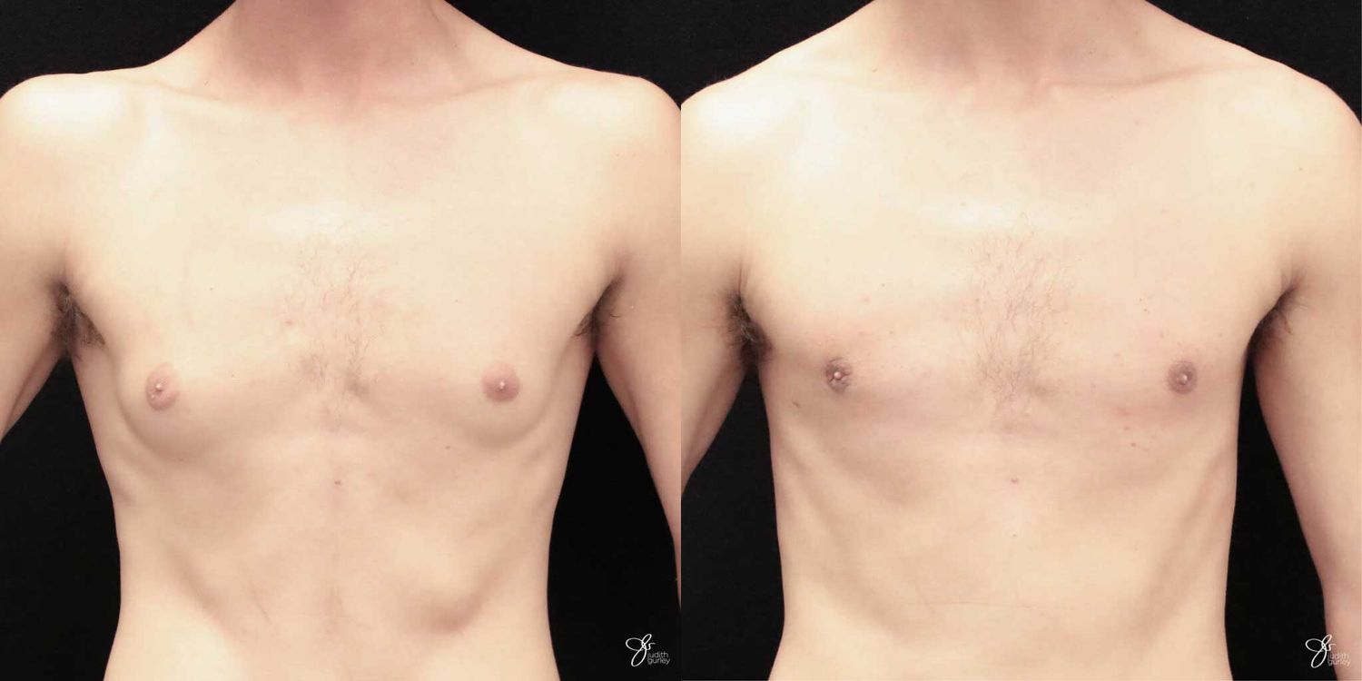 Gynecomastia Correction Before & After