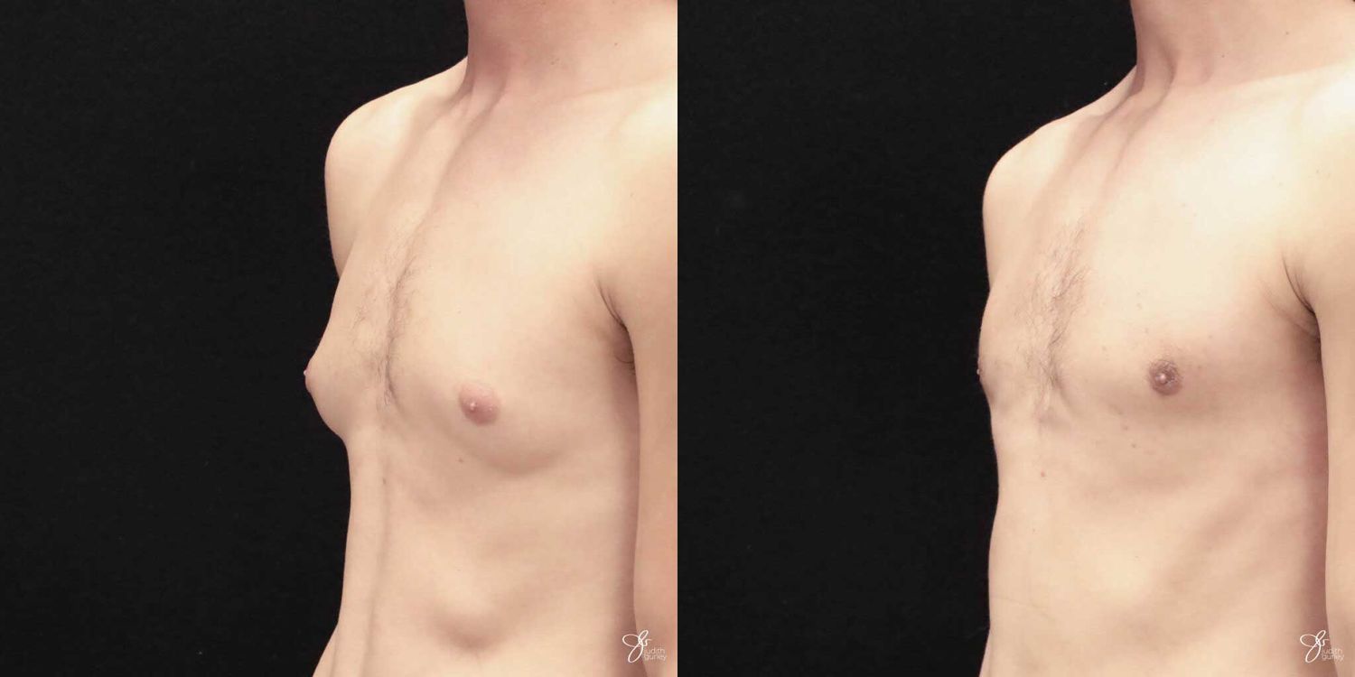 Gynecomastia Correction Before & After