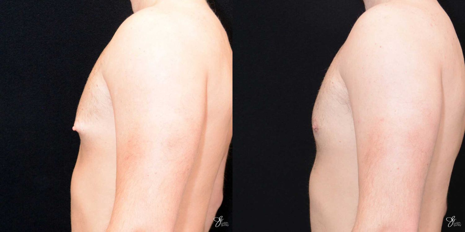 Gynecomastia Correction Before & After