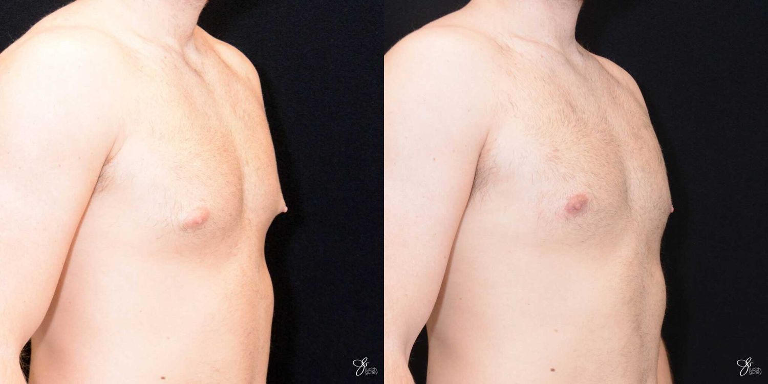 Gynecomastia Correction Before & After