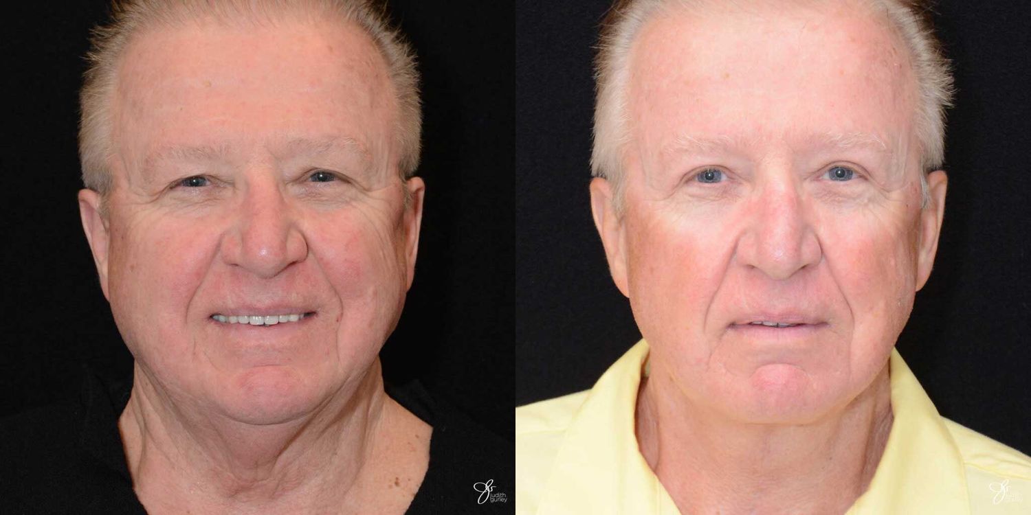 Face And Neck Lifts Before & After