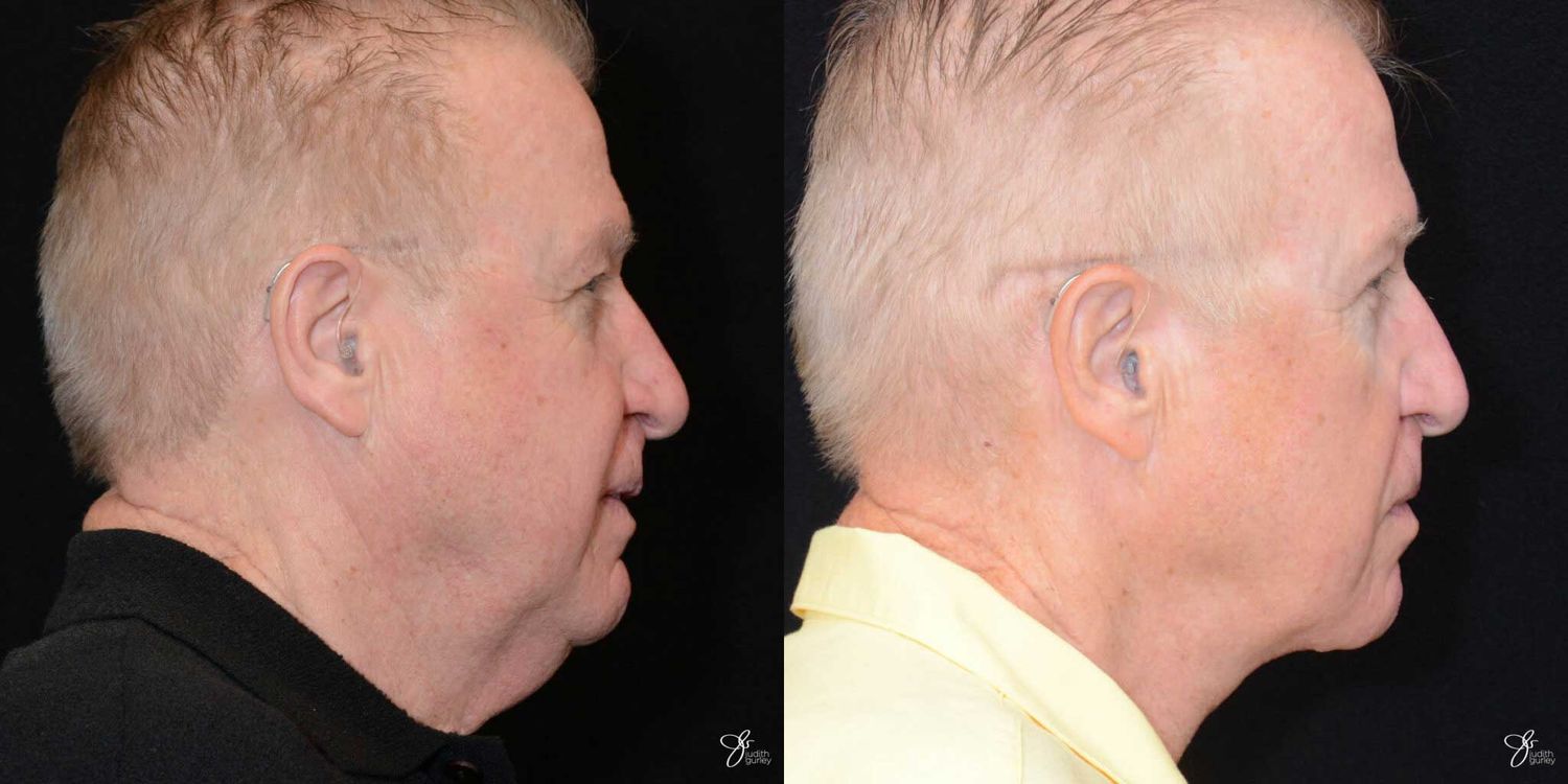 Face And Neck Lifts Before & After