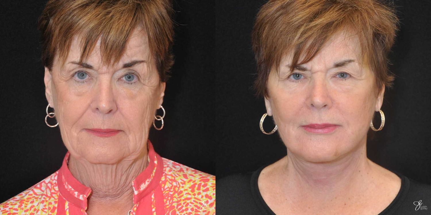 Face And Neck Lifts Before & After