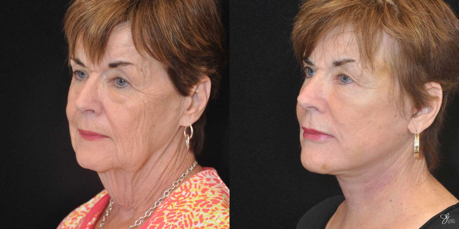 Face And Neck Lifts Before & After