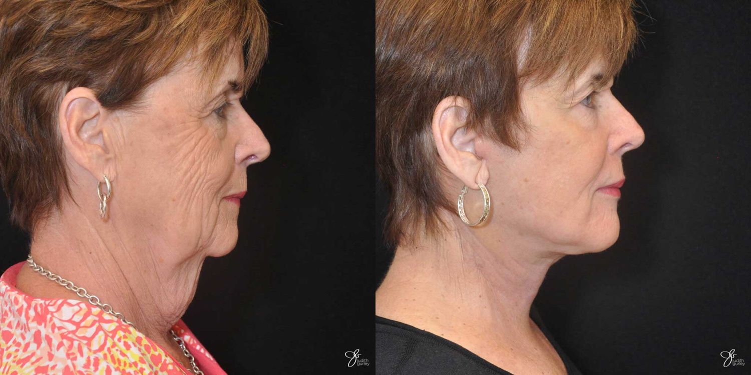 Face And Neck Lifts Before & After
