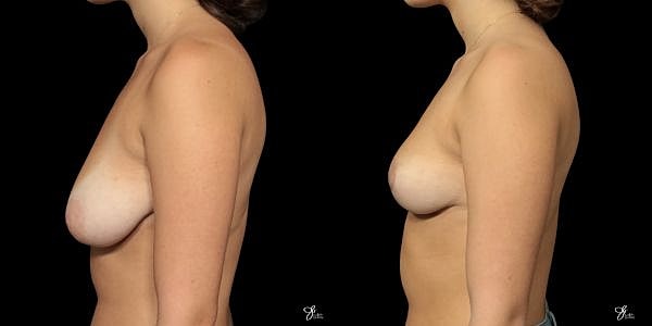 Areola Reduction Before & After