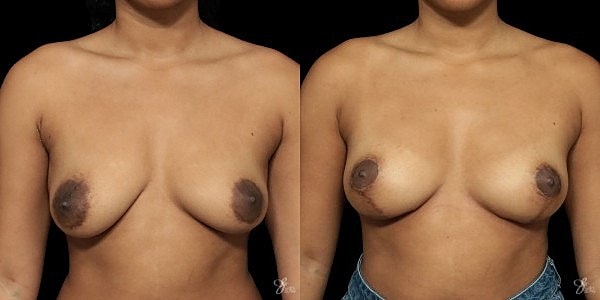 Areola Reduction Before & After