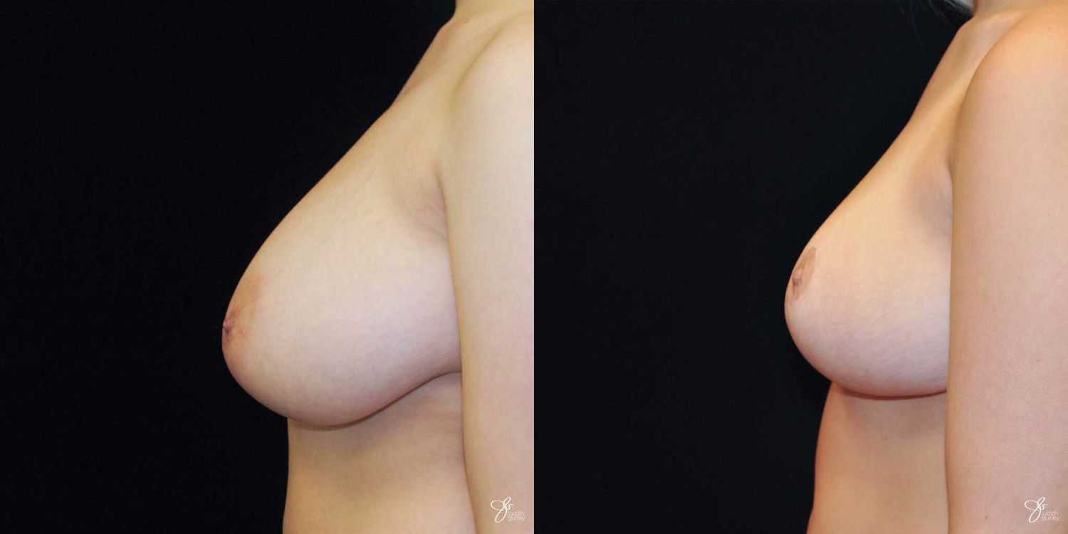 Areola Reduction Before & After