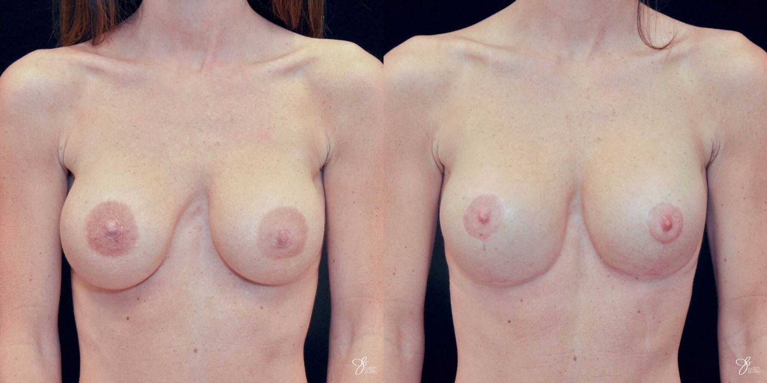Areola Reduction Before & After