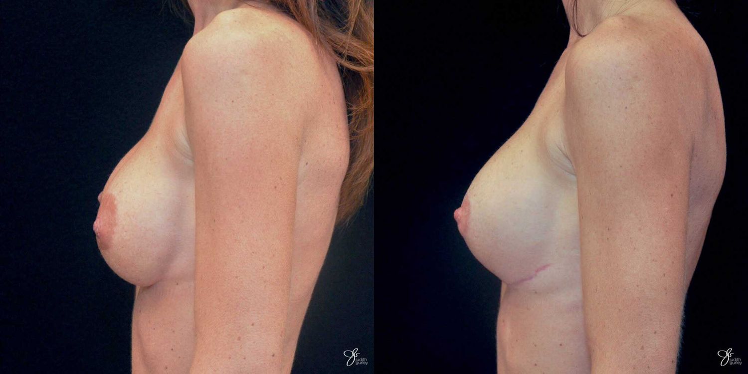 Areola Reduction Before & After