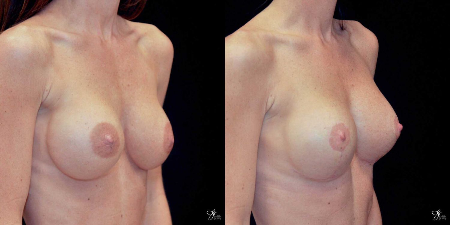 Areola Reduction Before & After