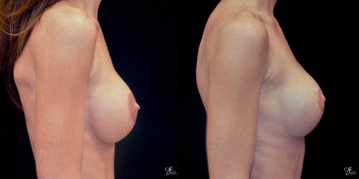 Areola Reduction Before & After