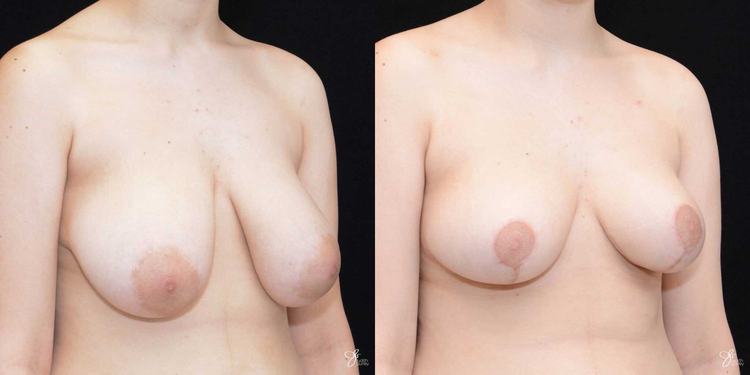 Areola Reduction Before & After