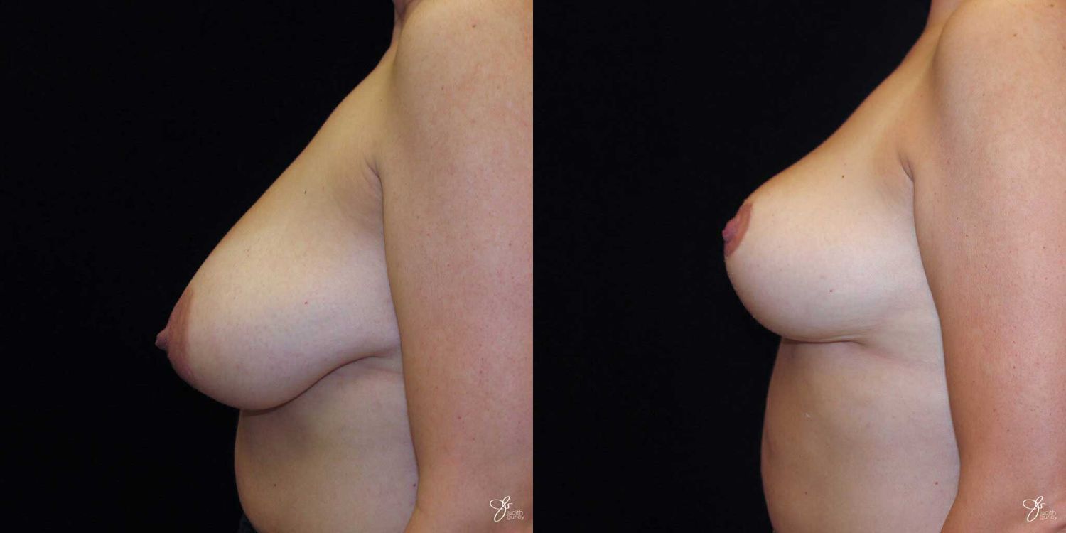 Areola Reduction Before & After
