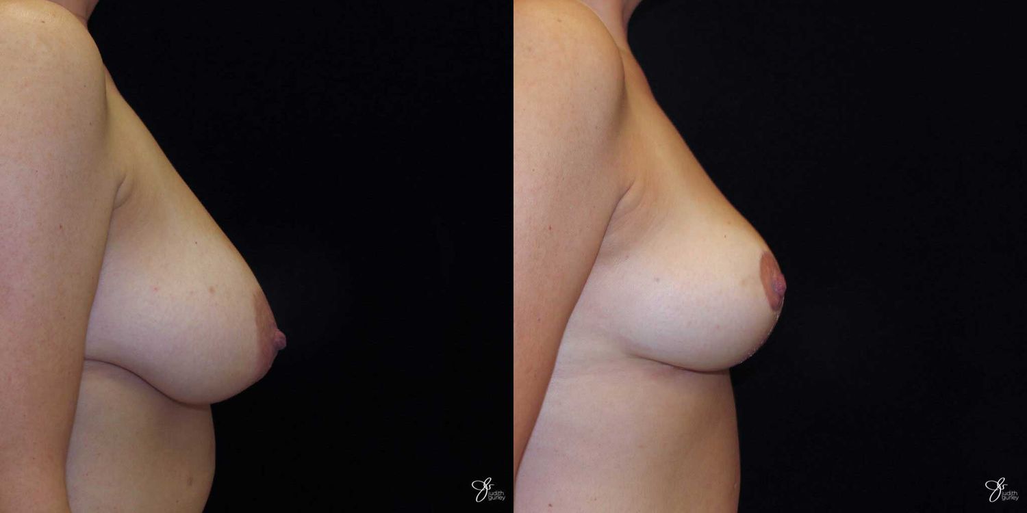 Areola Reduction Before & After