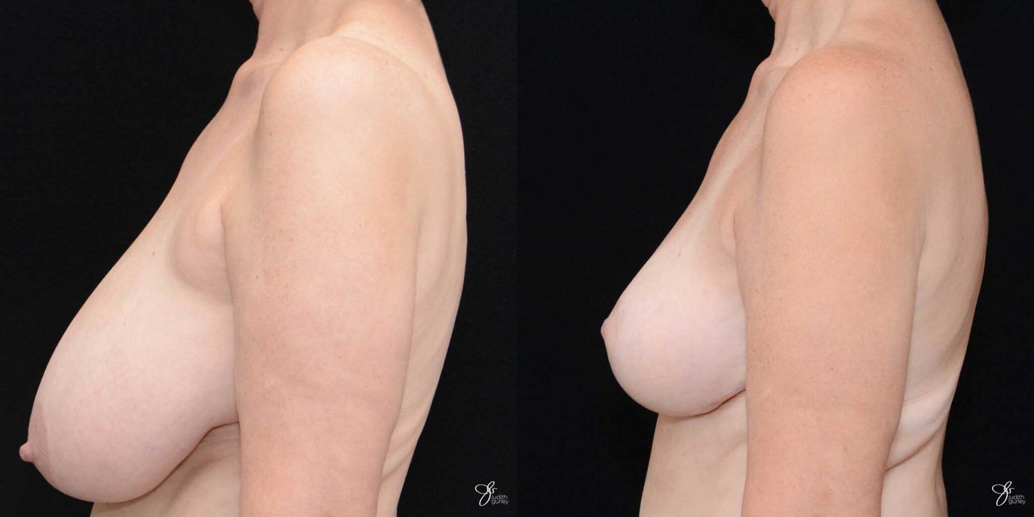 Areola Reduction Before & After