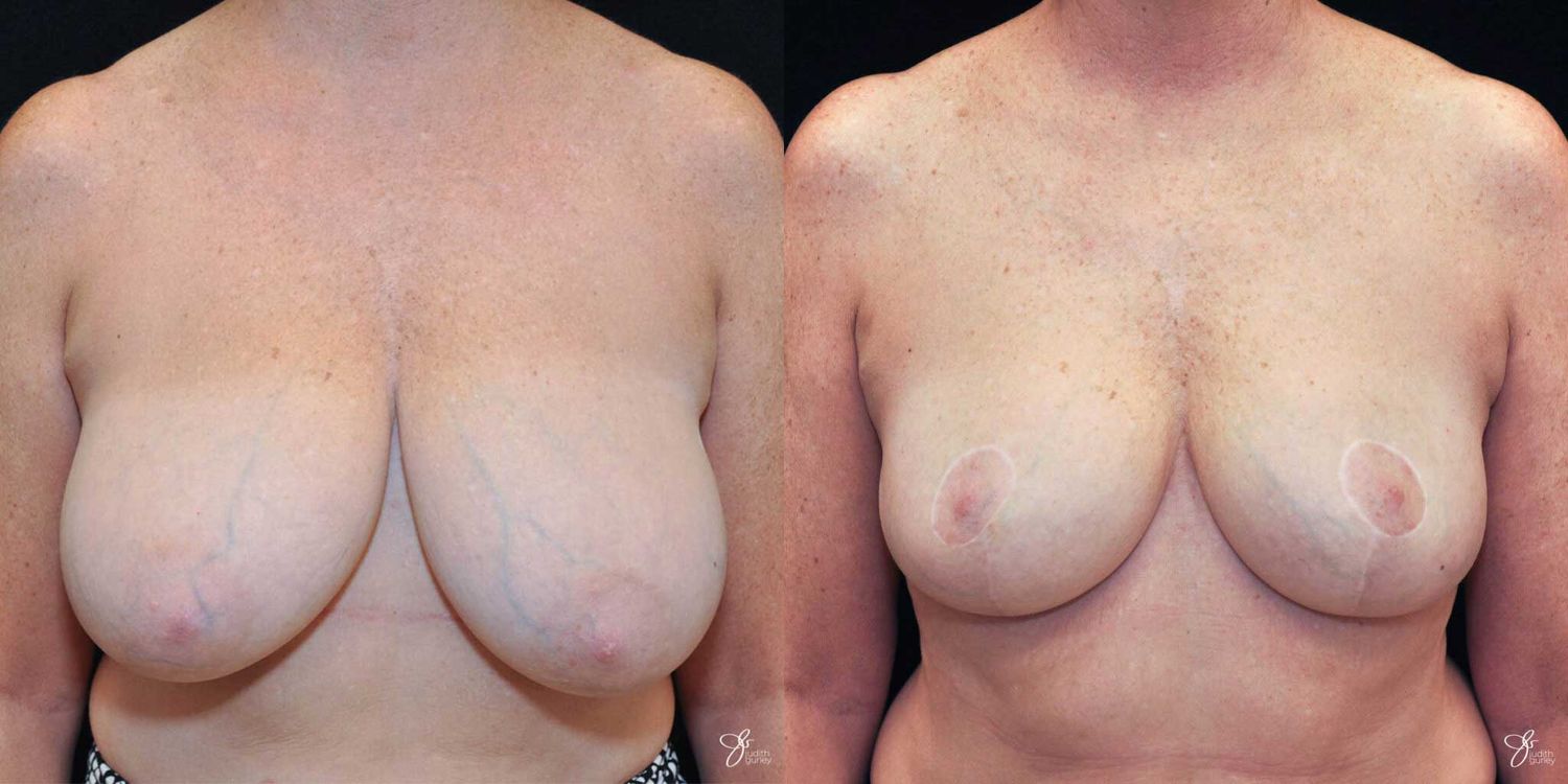 Areola Reduction Before & After