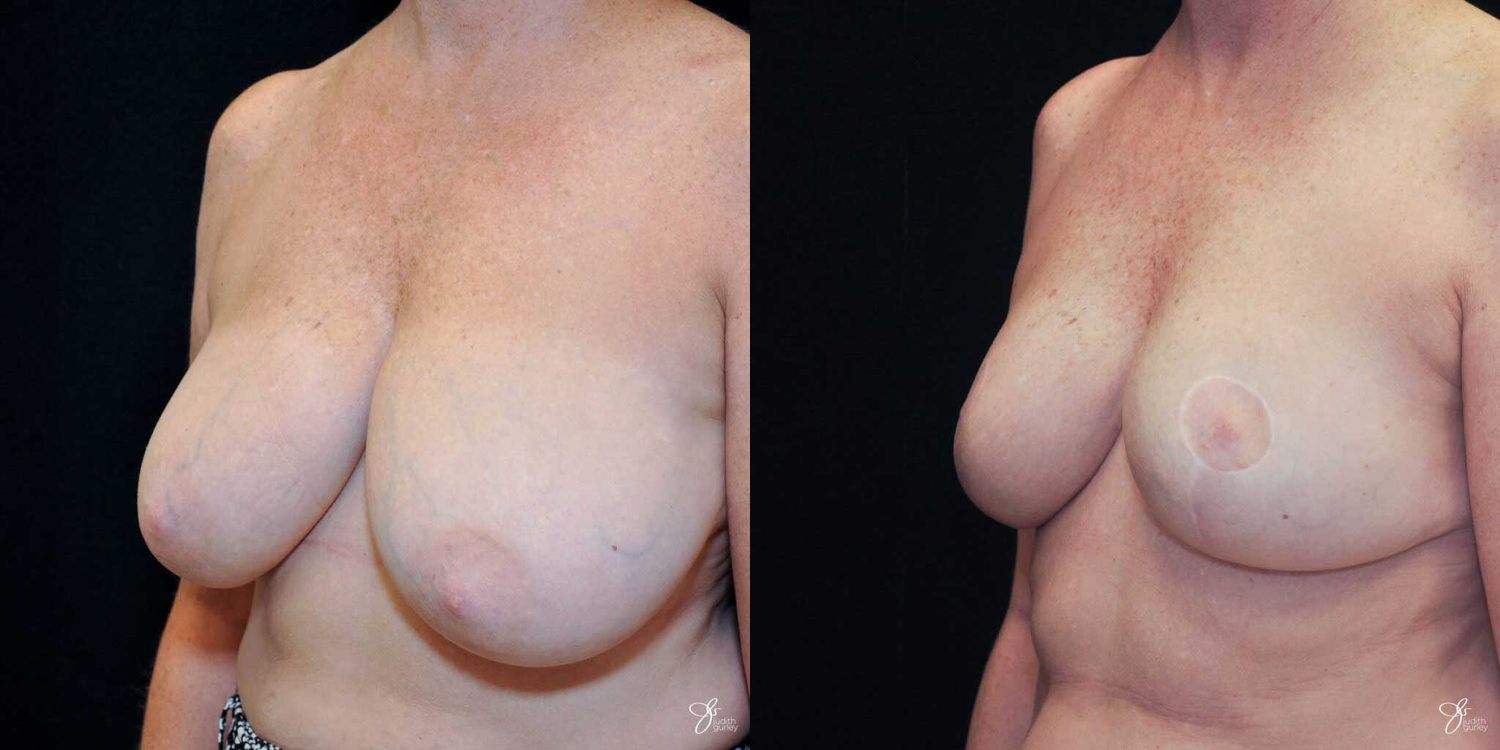 Areola Reduction Before & After