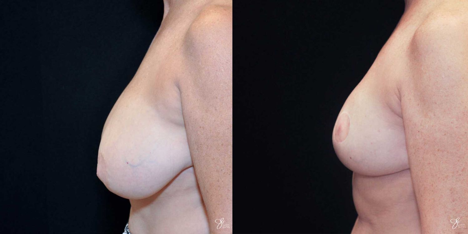 Areola Reduction Before & After