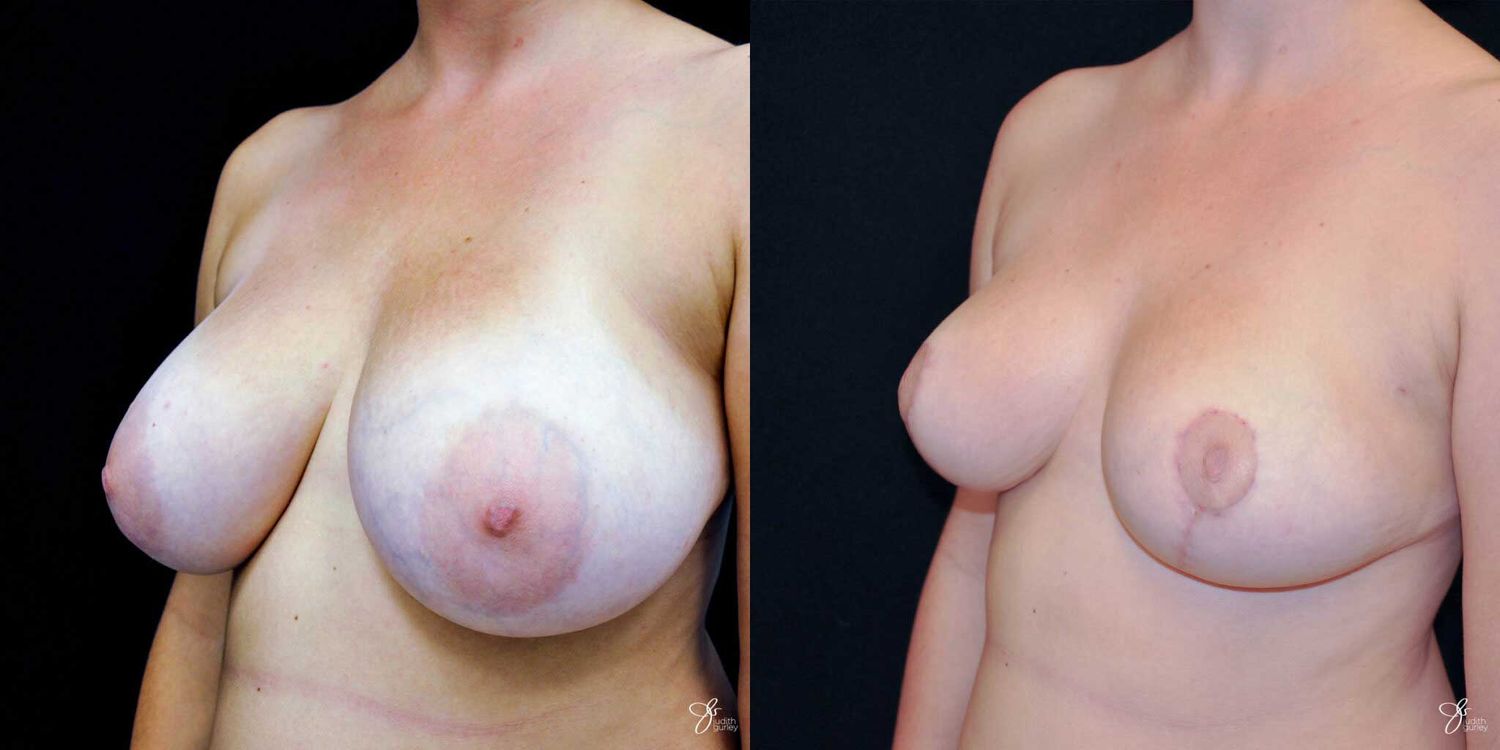 Areola Reduction Before & After