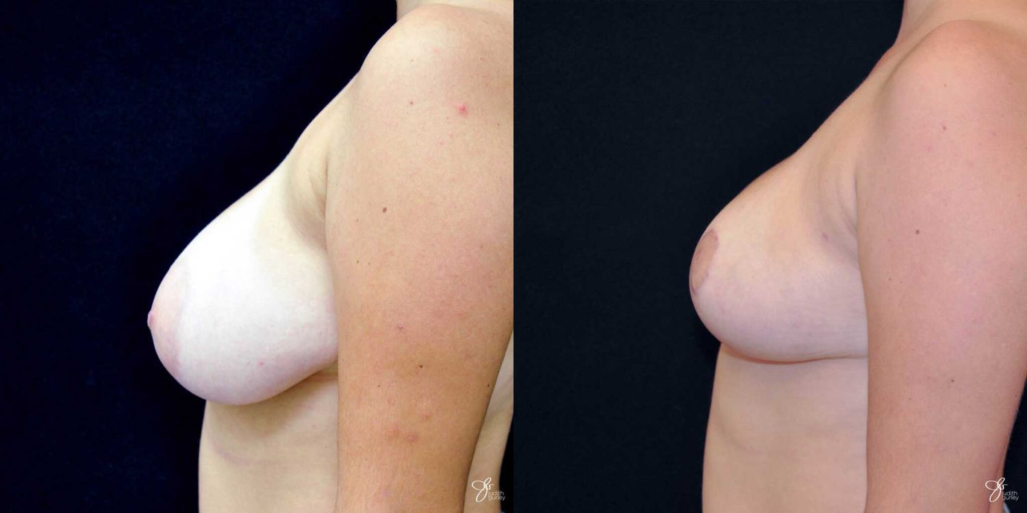 Areola Reduction Before & After