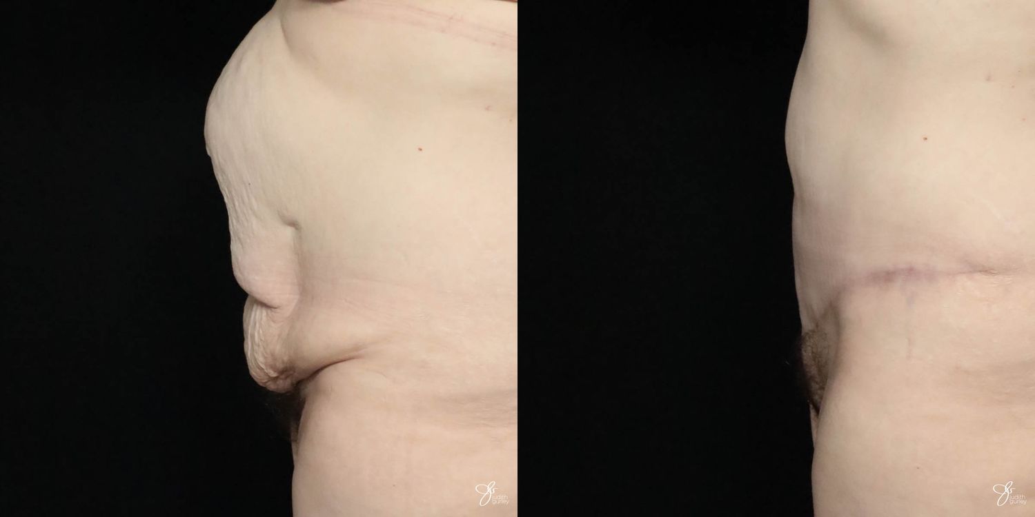 Body Lift Before & After