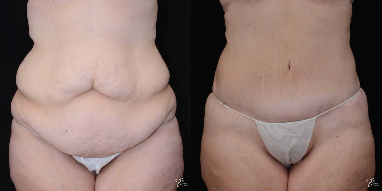 Body Lift Before & After