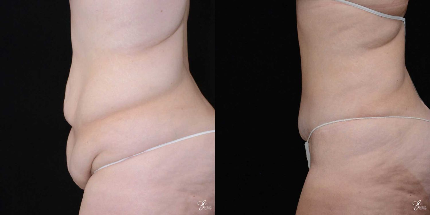 Body Lift Before & After