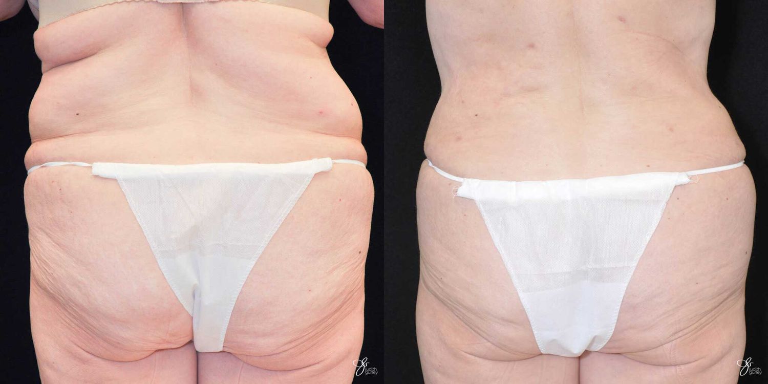 Body Lift Before & After