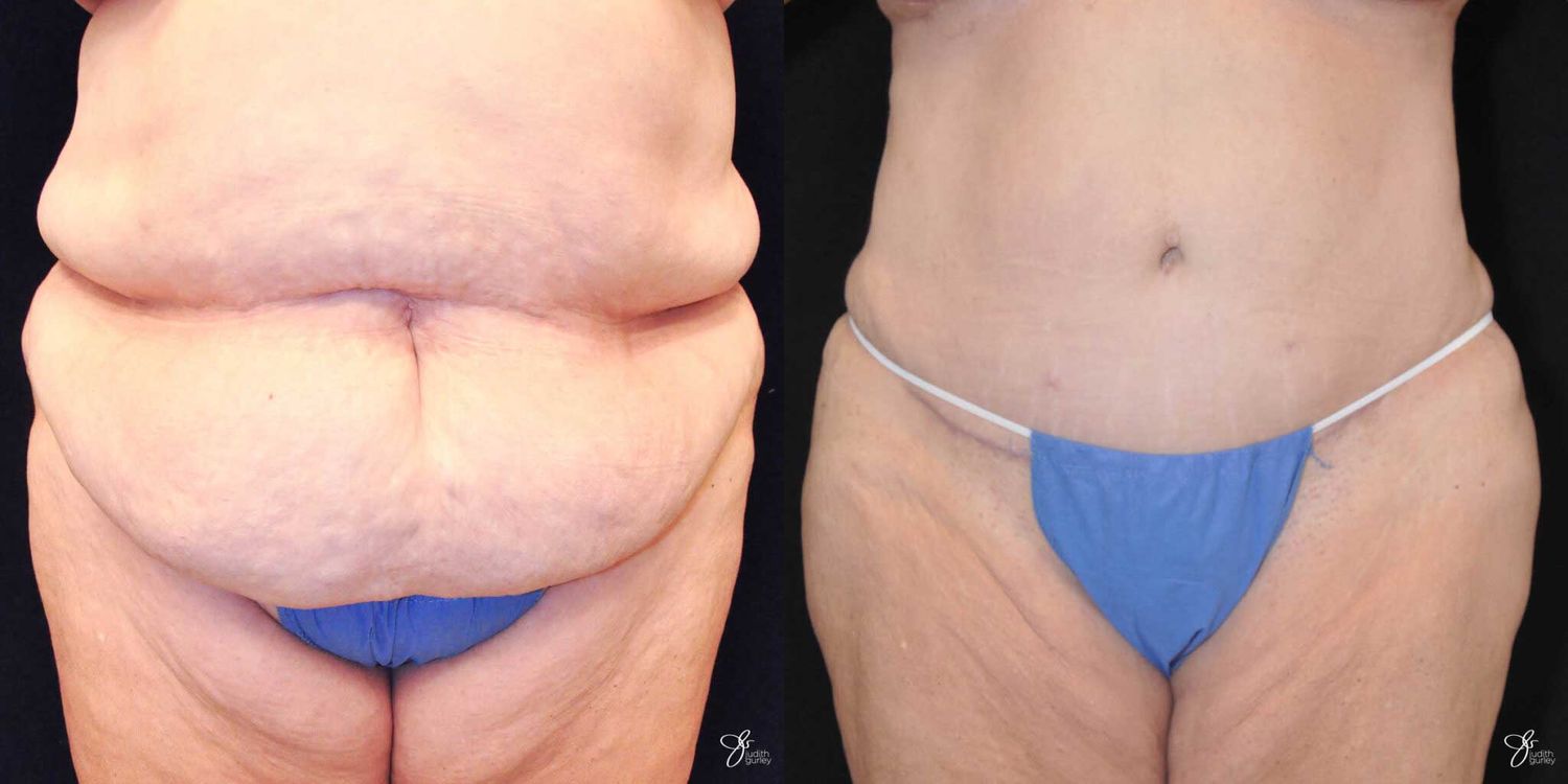Body Lift Before & After