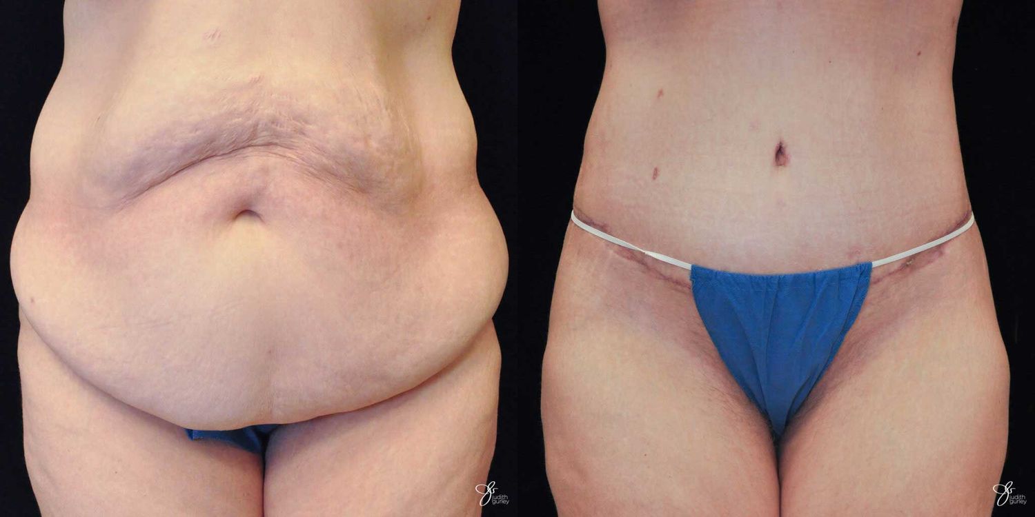 Body Lift Before & After