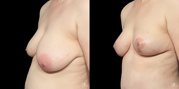 Asymmetry Correction Before & After