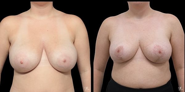 Asymmetry Correction Before & After