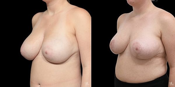 Asymmetry Correction Before & After