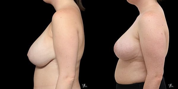 Asymmetry Correction Before & After