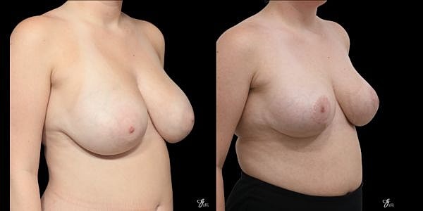 Asymmetry Correction Before & After