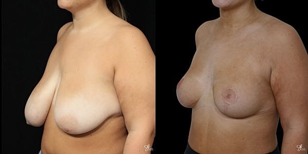 Asymmetry Correction Before & After